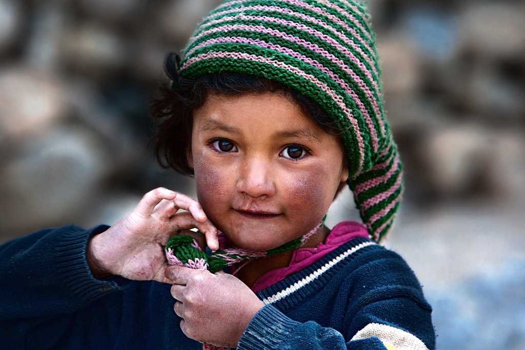 The devastating effects of frost on the skin of children