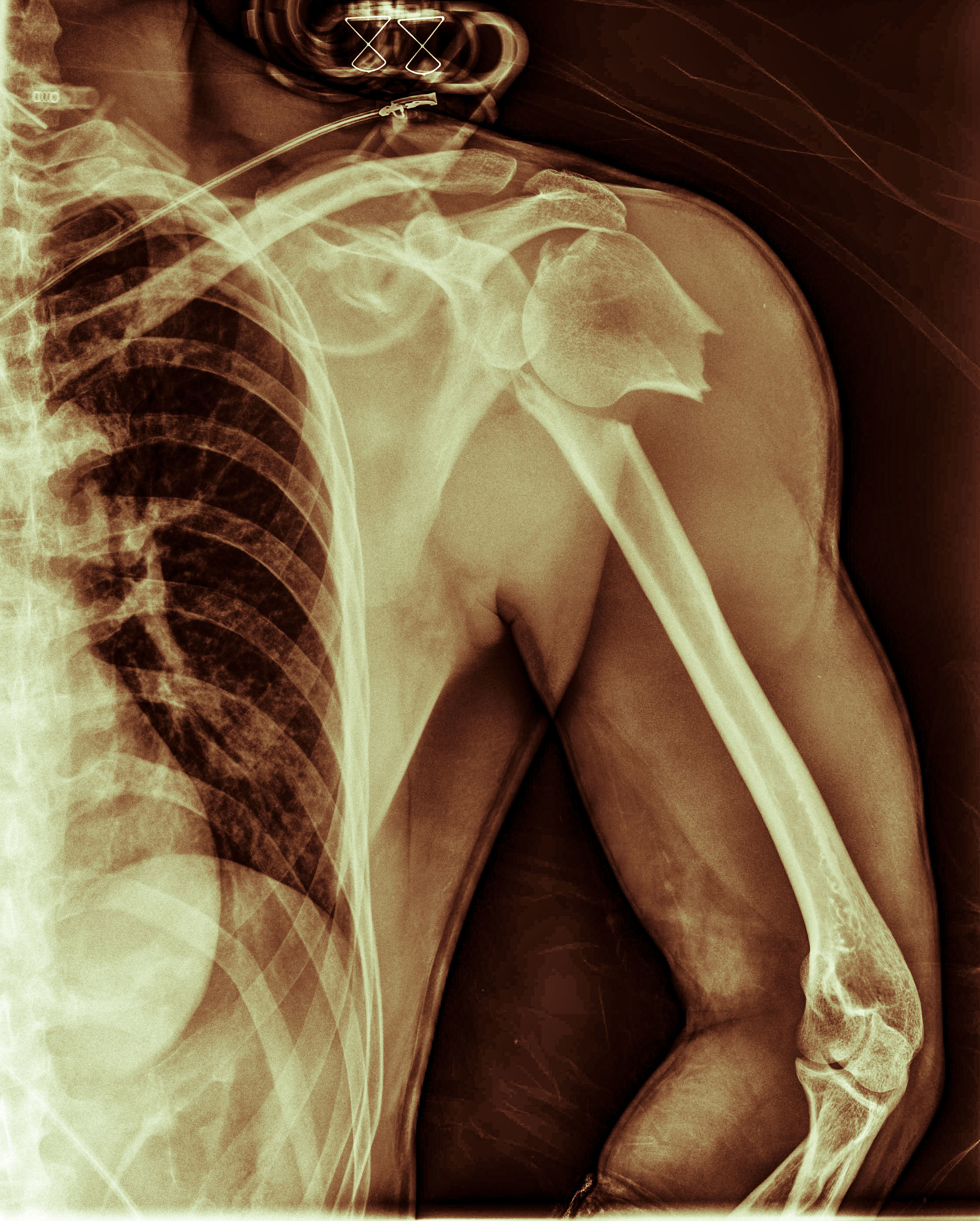 My shoulder, October 5th 2015