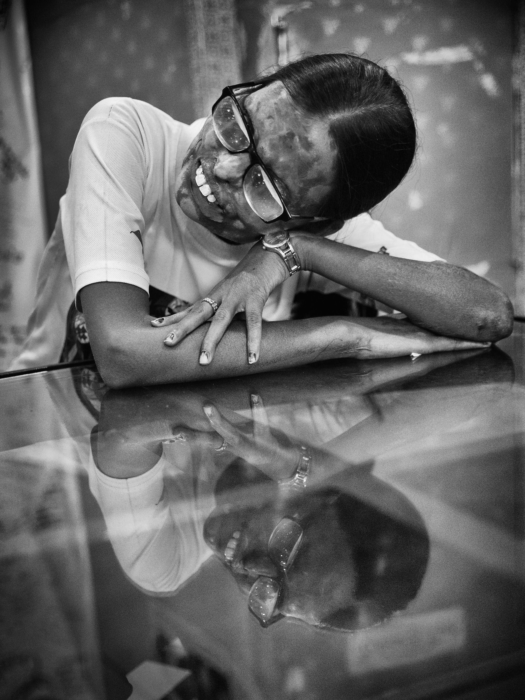 Acid attack victim, Agra, 2018.