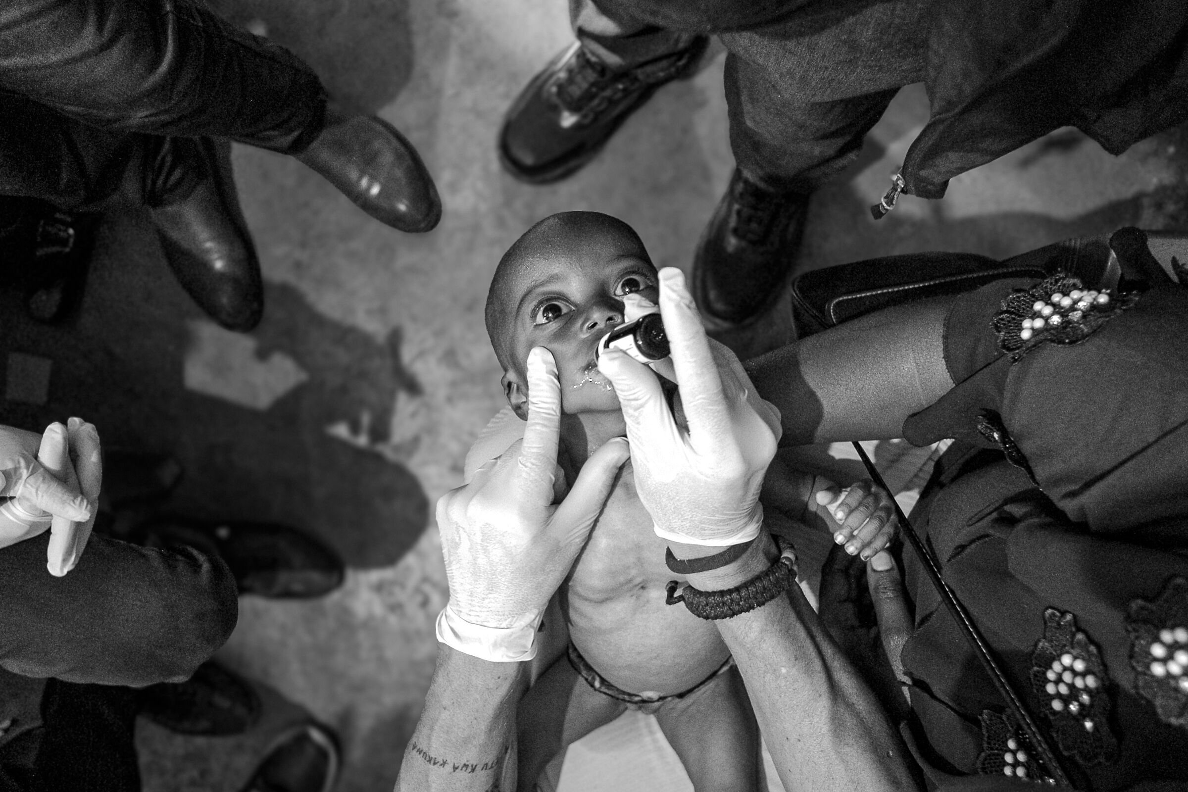 Malnutrizione 2024 Repubblica Democratica del Congo