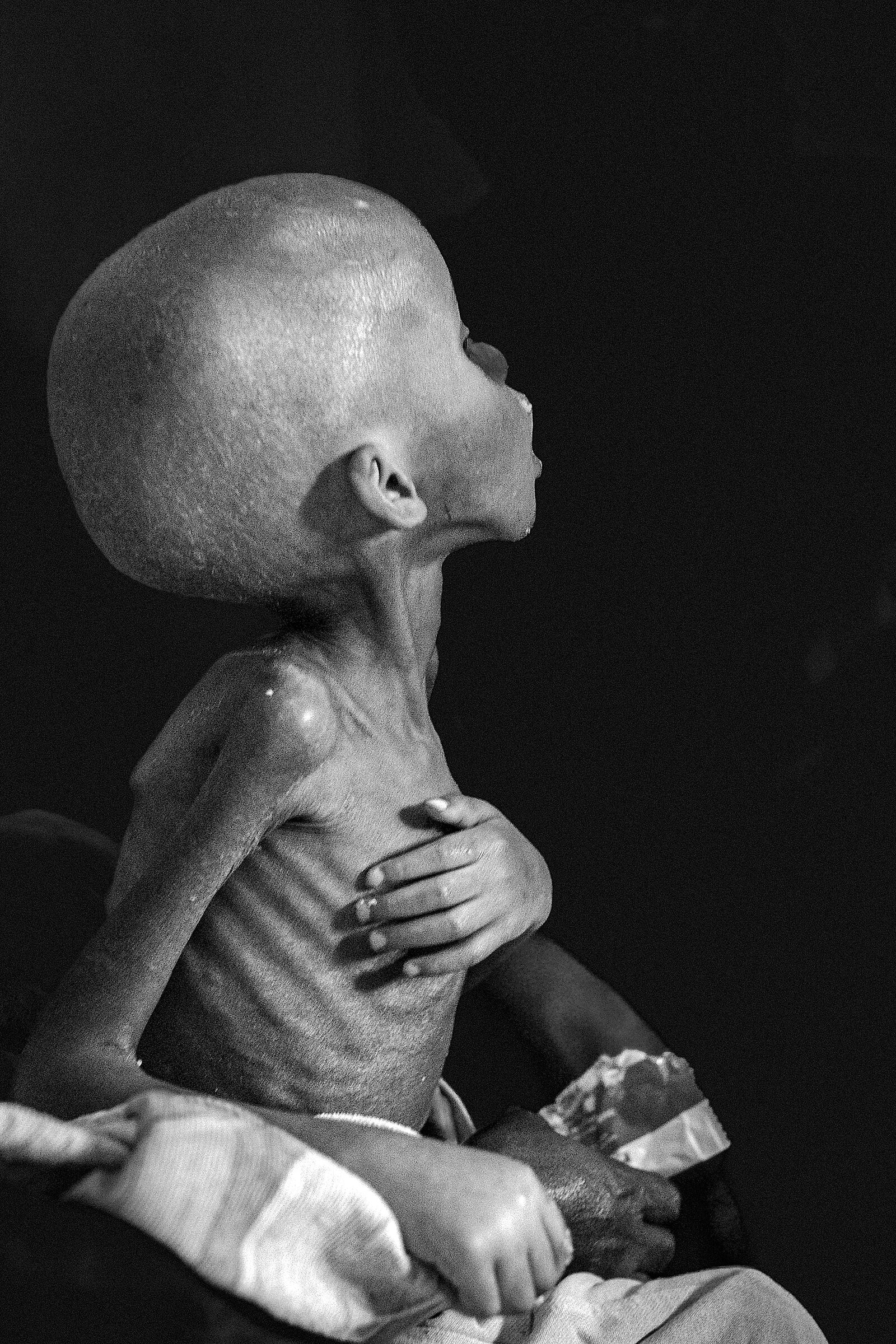 Malnutrition Democratic Republic of the Congo