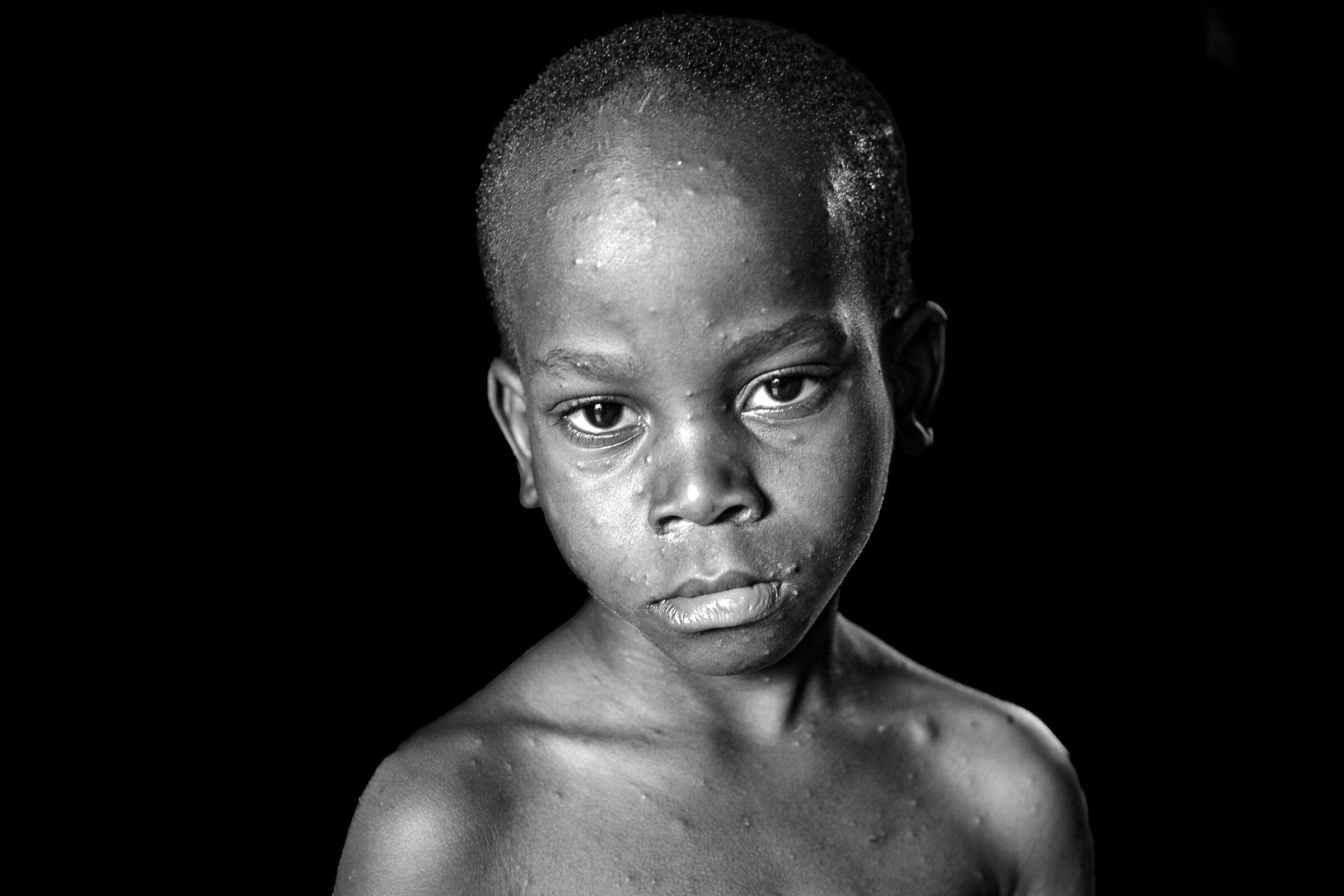 Vaiolo delle Scimmie - RDC 2024