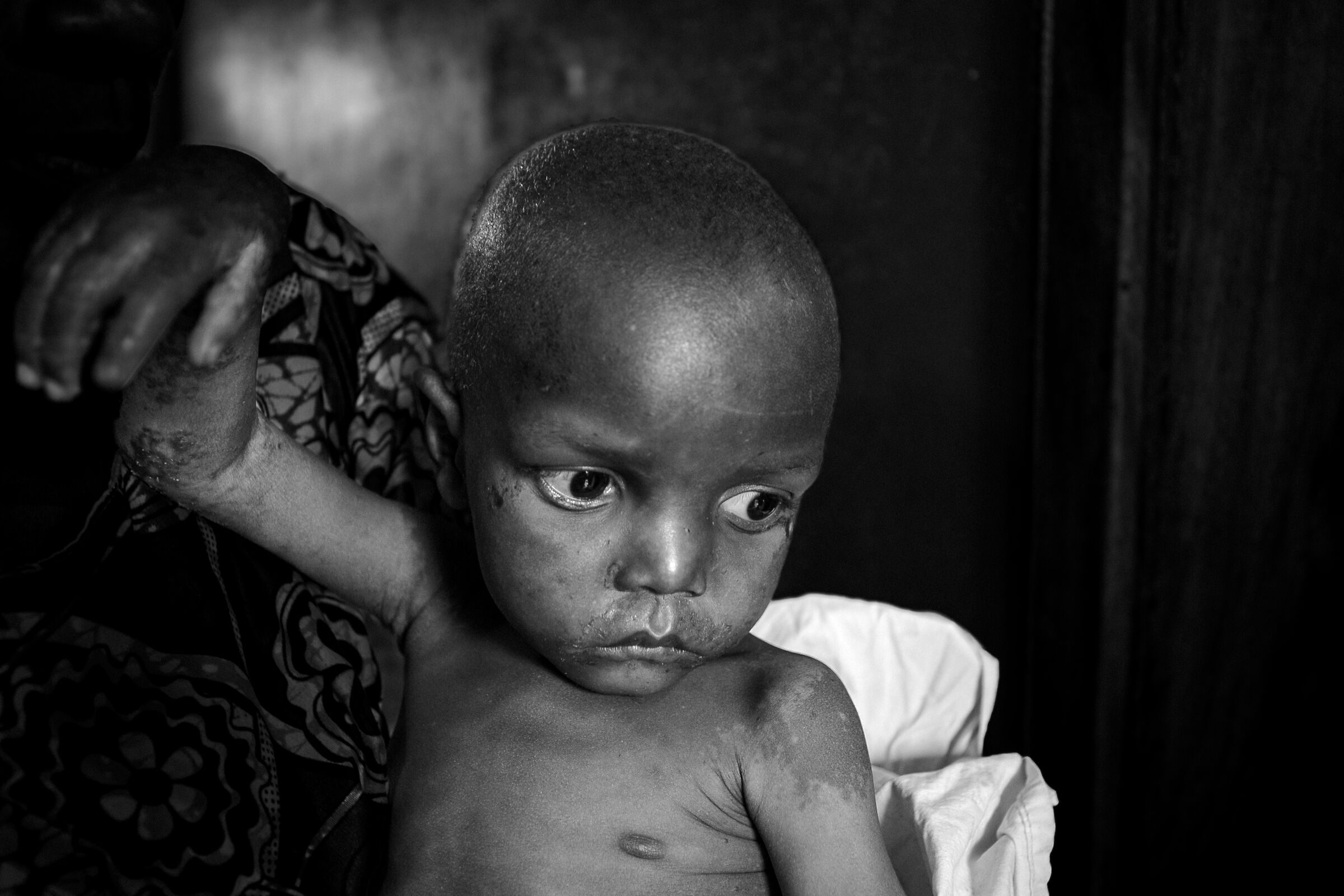 malnutrition Democratic Republic of the Congo