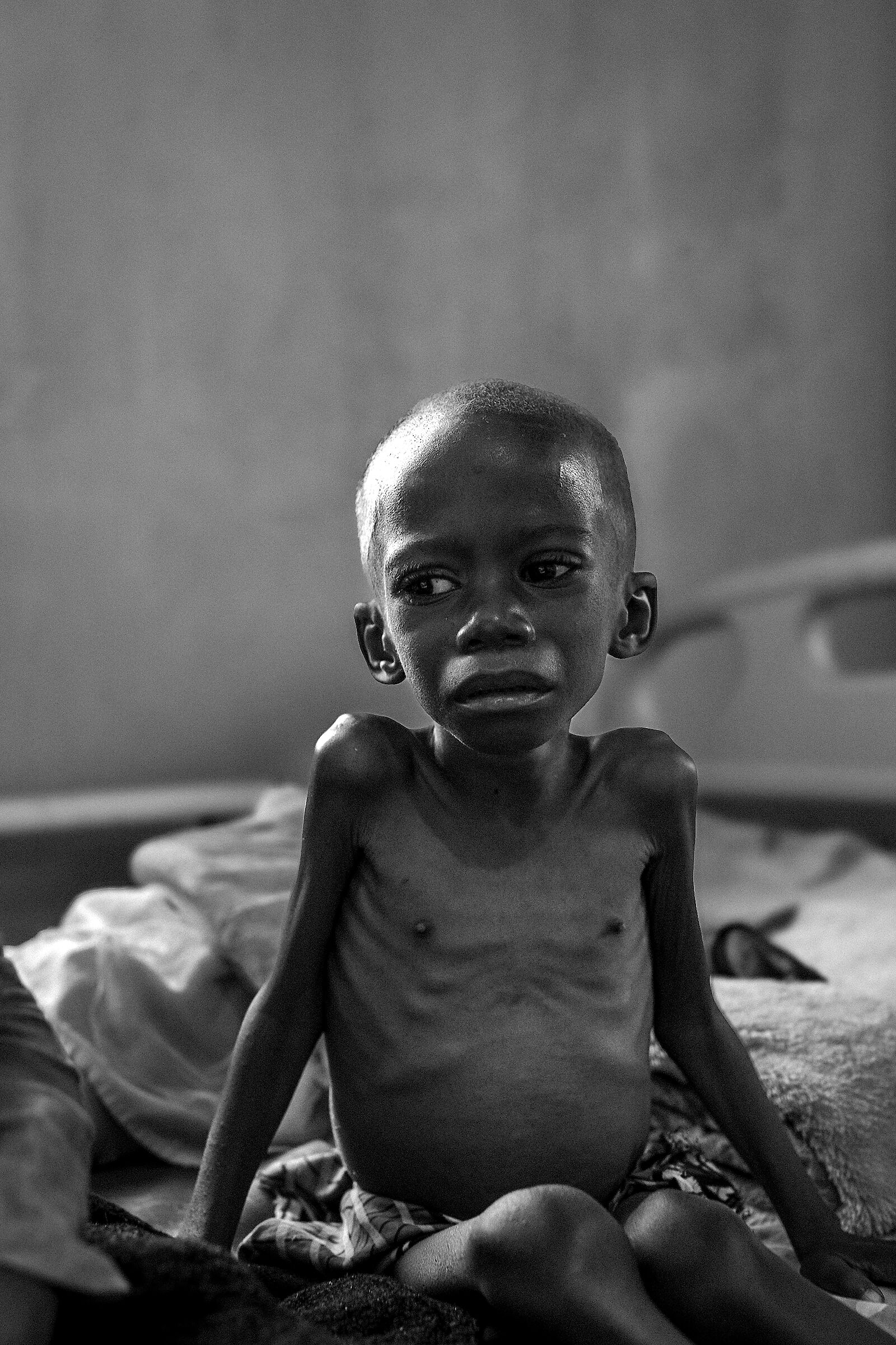 Malnutrition 2024 Democratic Republic of Congoone