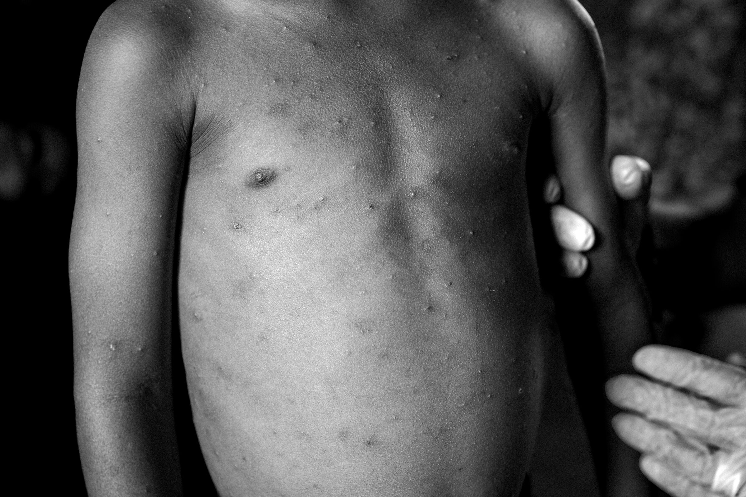 Monkeypox - DRC 2024