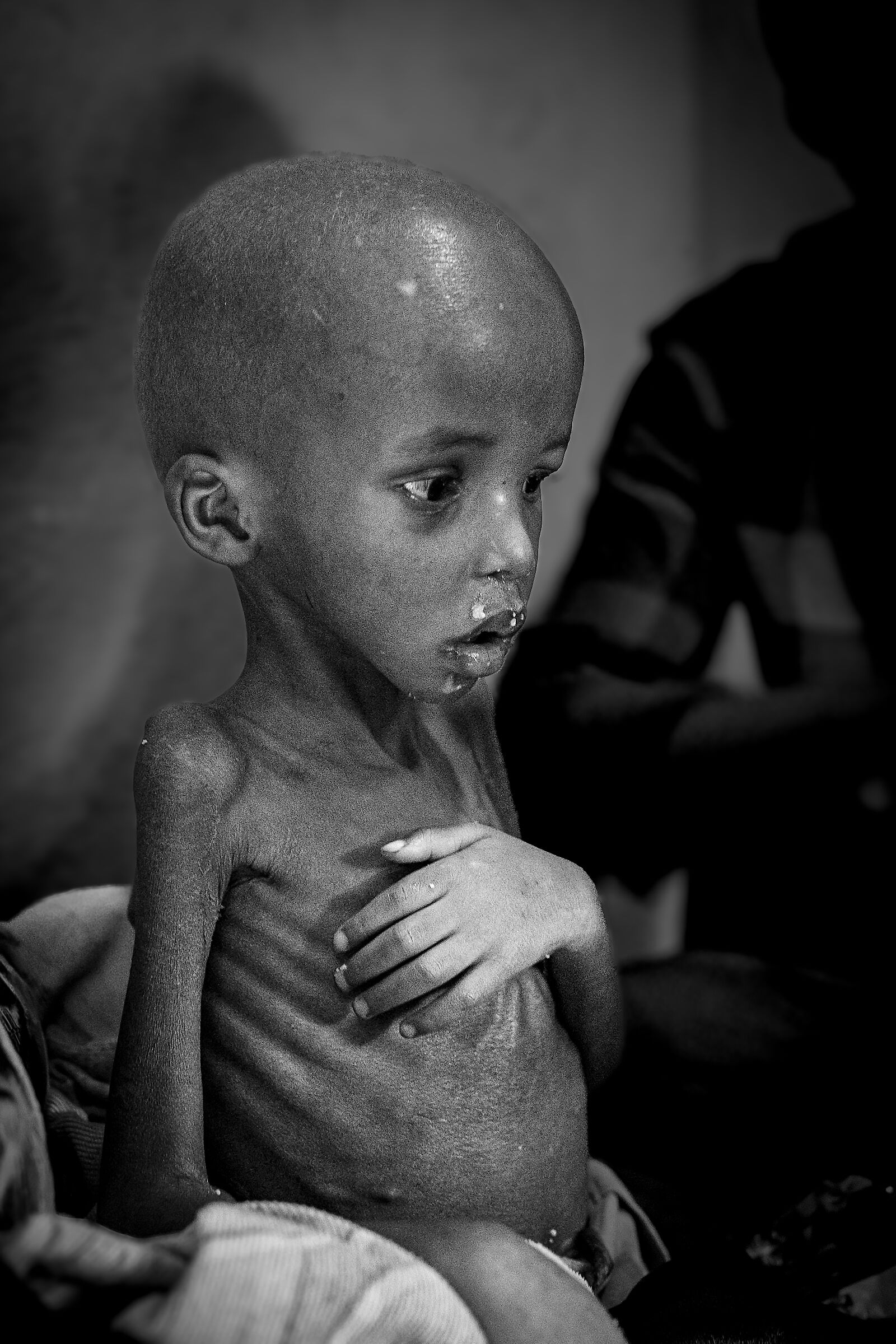 malnutrizione 2024 Repubblica Democratica del Congo