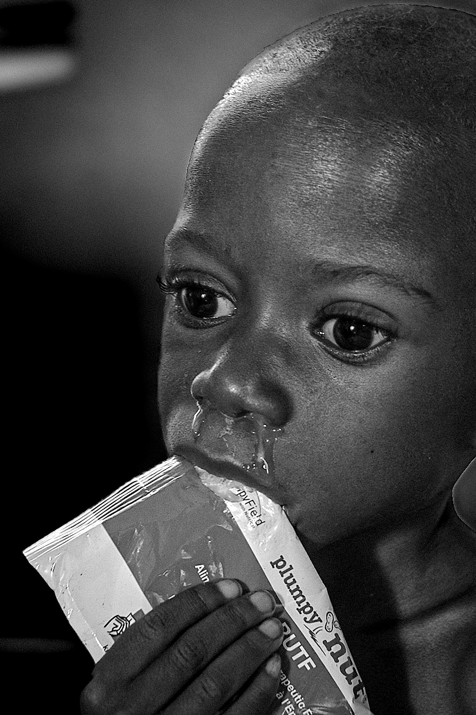 malnutrition 2024 Democratic Republic of the Congo