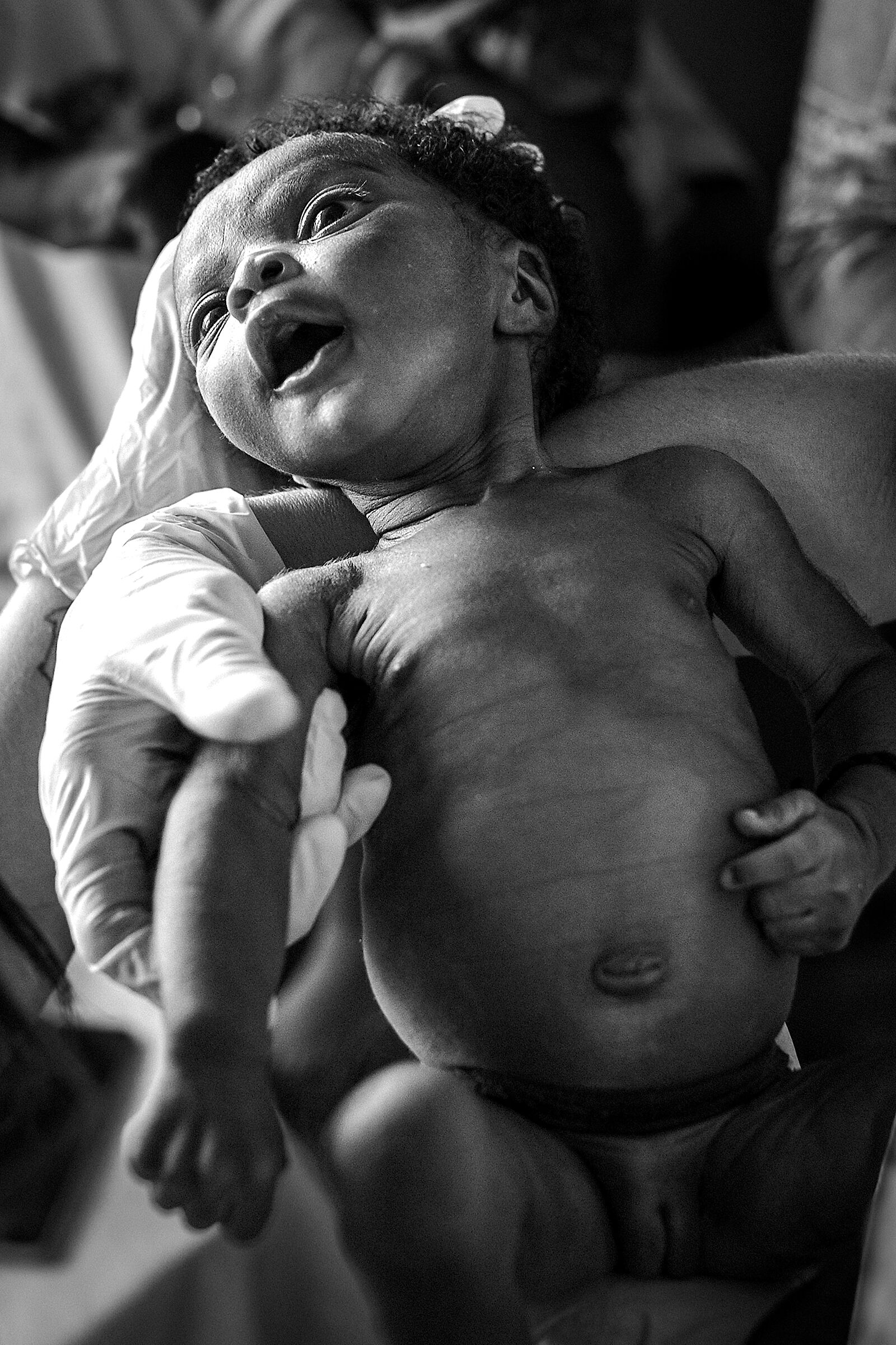 malnutrition 2024 Democratic Republic of the Congo