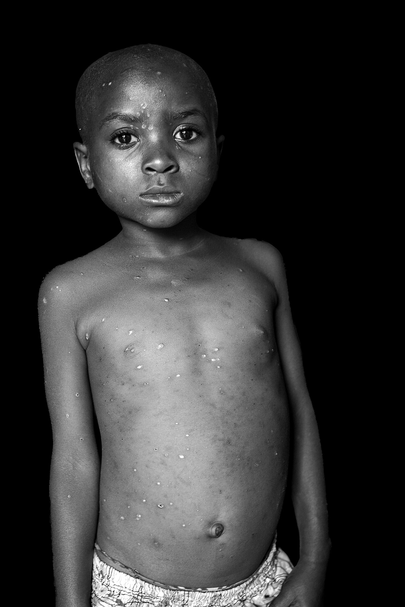 malnutrizione 2024 Repubblica Democratica del Congo