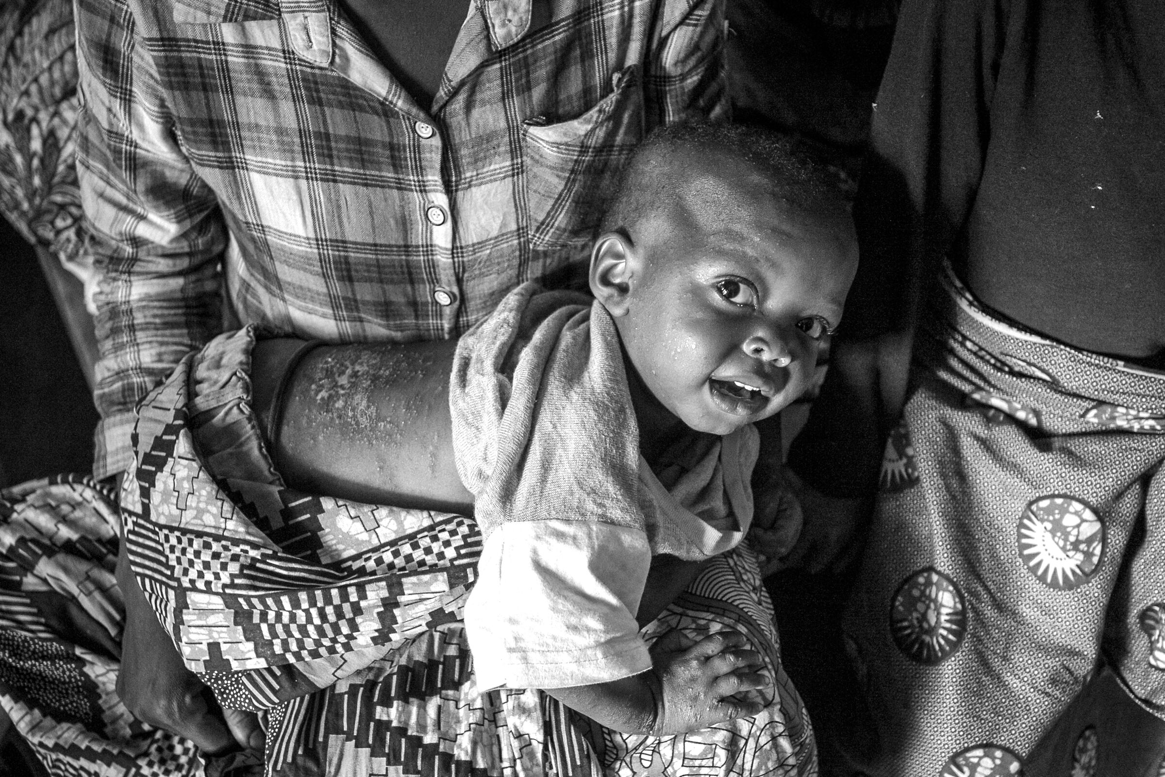 In the Bukavu Hospital in the DRC - Scabies