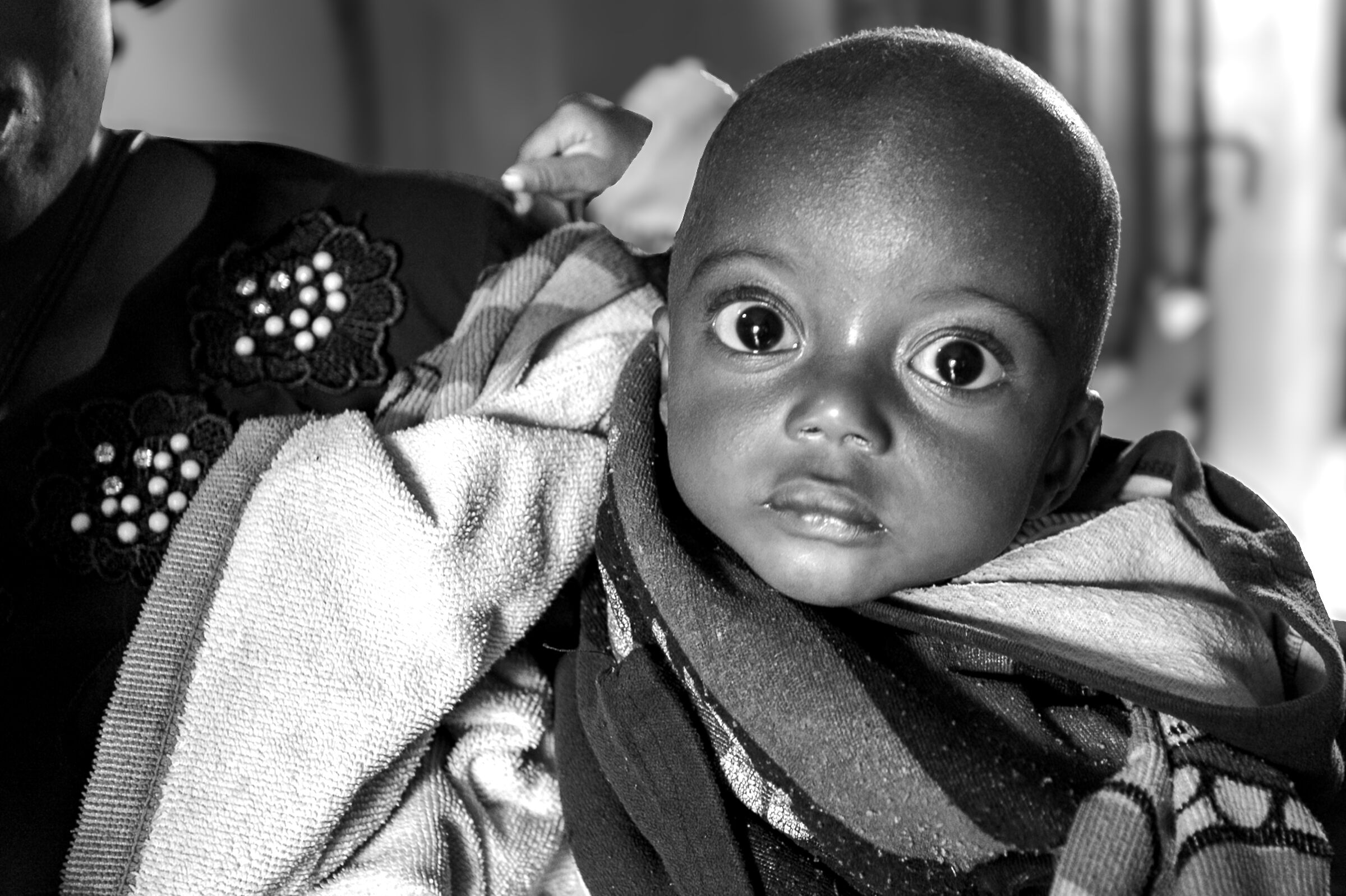 Malnutrition 2024 Democratic Republic of Congo