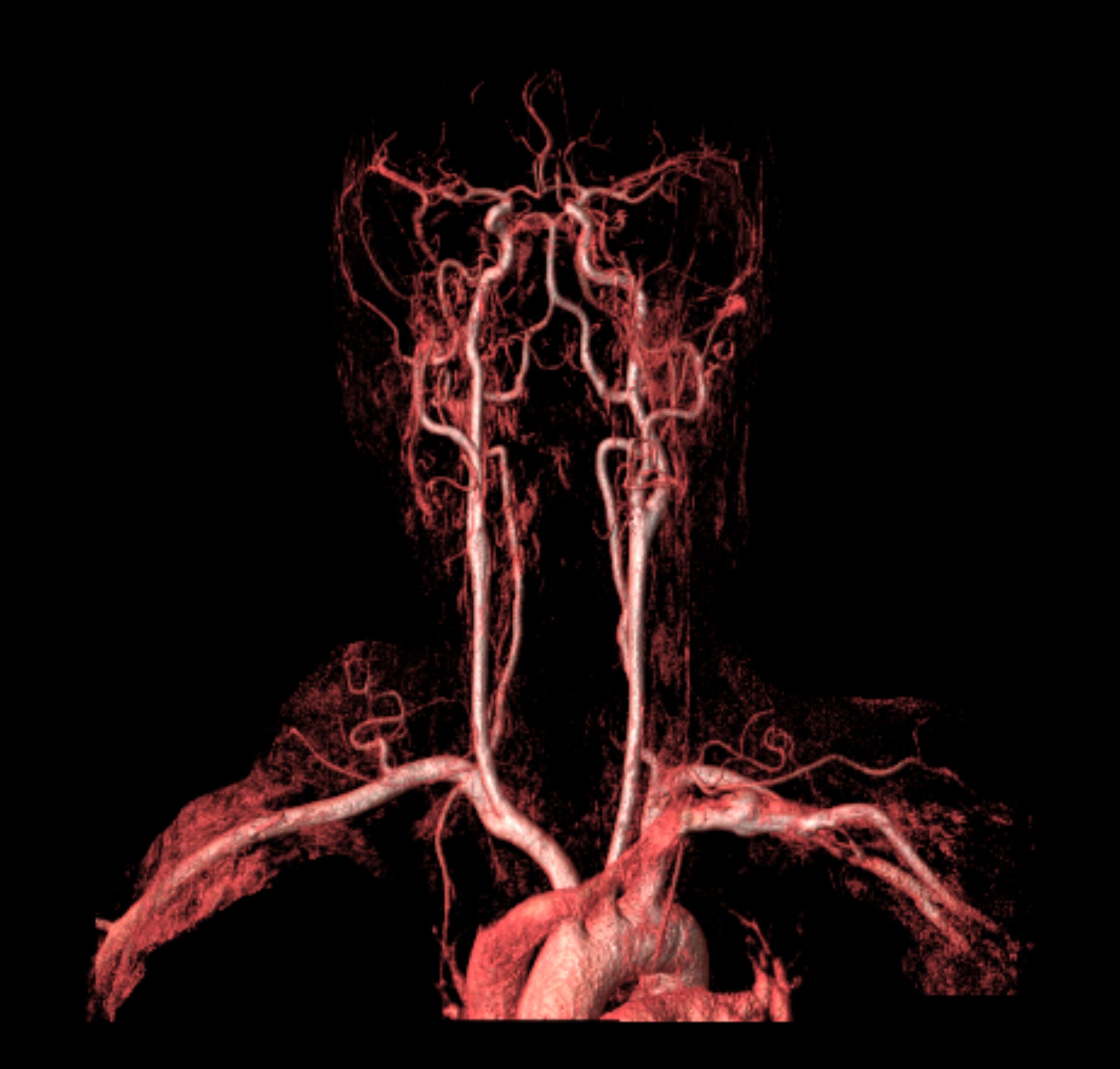RM Venoso  Tronco alla testa