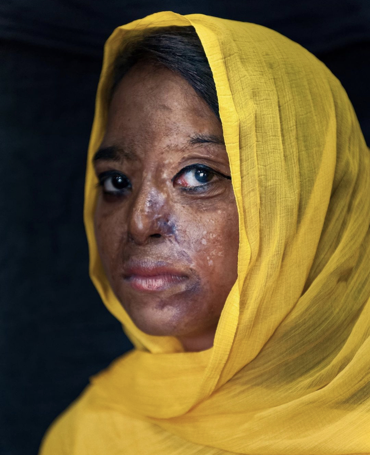 Skin project, India