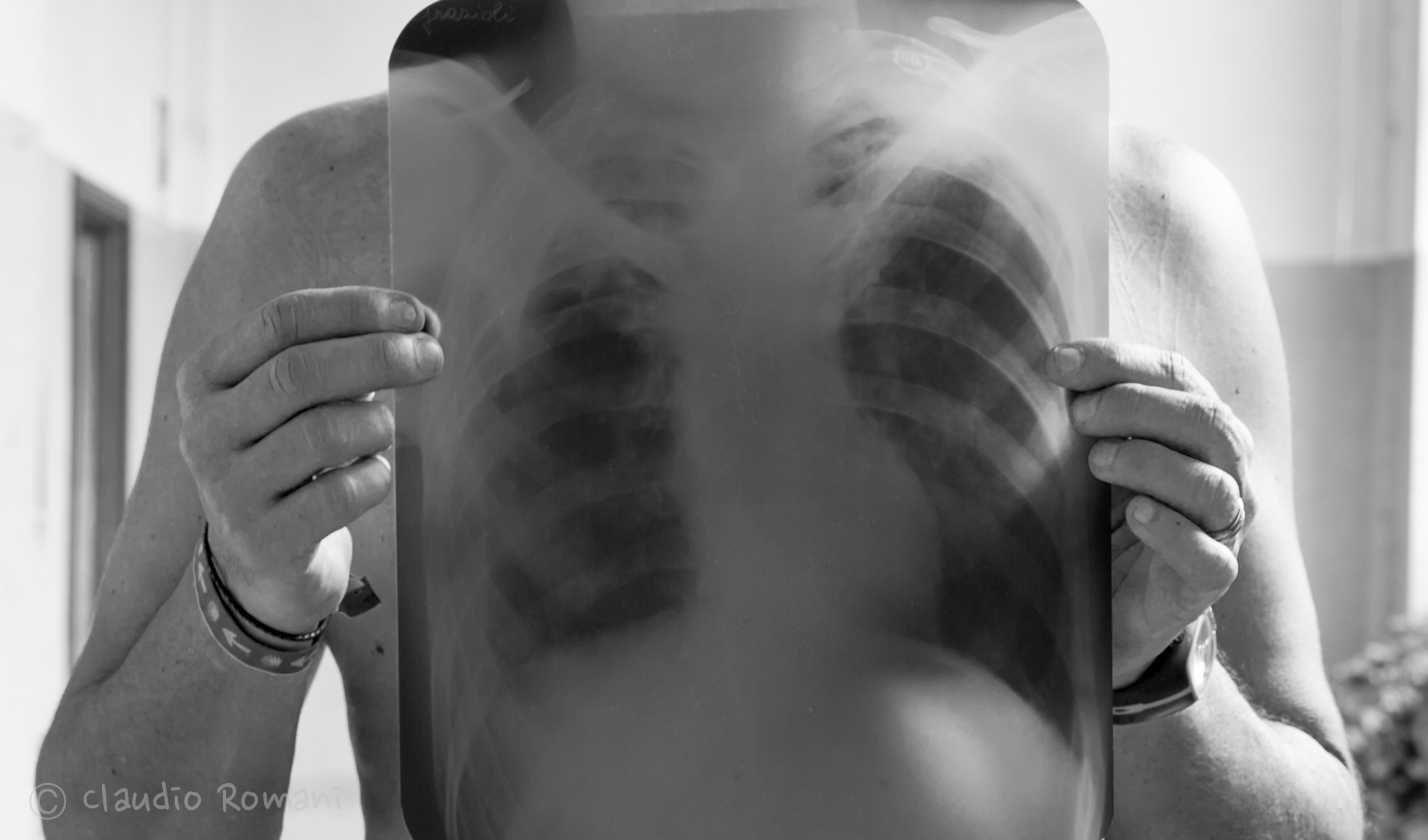 Nosocomio a pieni polmoni